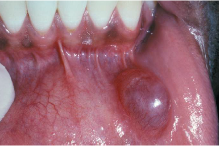 O que é Mucocele - Imagem de uma mucocele no lábio inferior