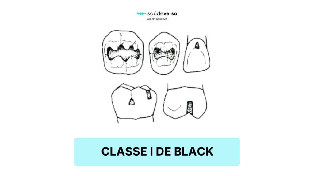 Classificação I de Black. Classe 1