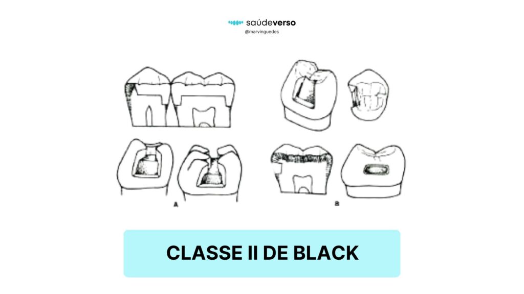 Classificação 2 de Black. Classe II