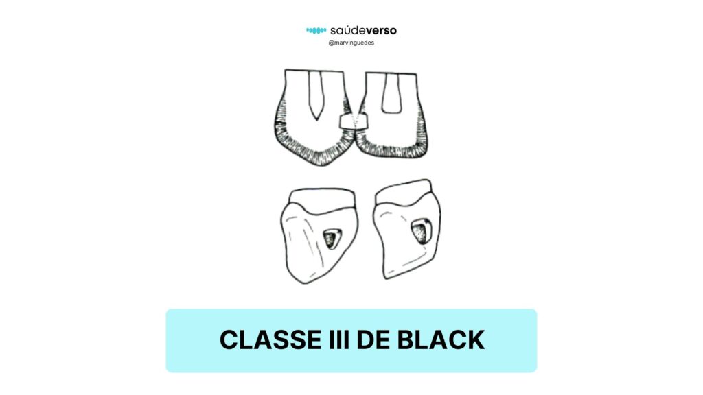 Classificação 3 de Black. Classe III