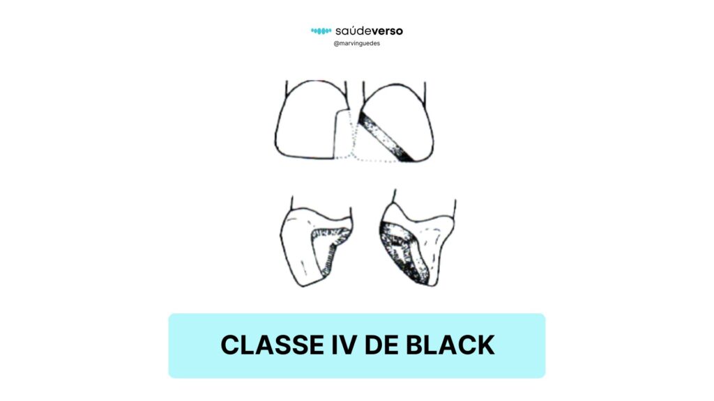 Classificação 4 de Black. Classe IV