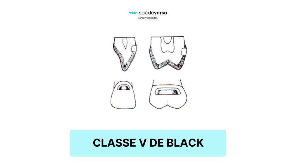 Classificação 5 de Black. Classe V