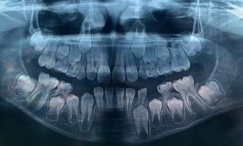 Radiografia panoramica detalhando o osso alveolar