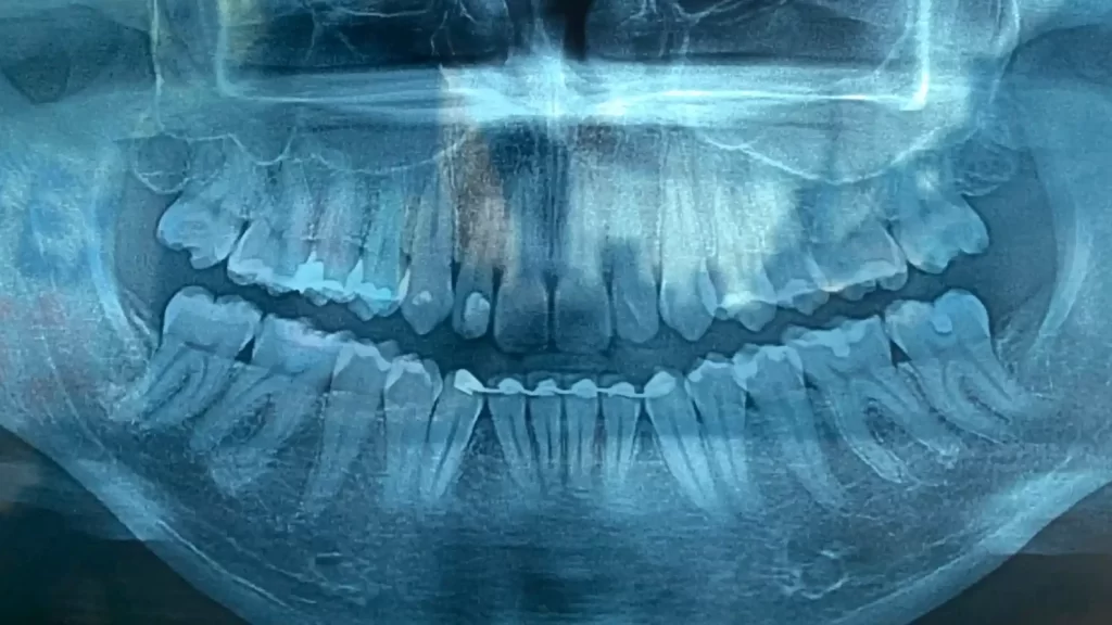 Segunda Radiografia panoramica detalhando o osso alveolar